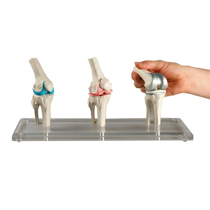 Knie-Implantat-Modell mit zwei Kniegelenken und Hand beim Einsetzen eines Einsatzes