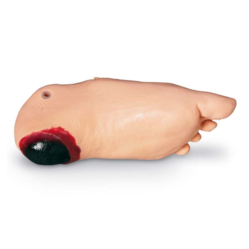 Puppen-Fuß mit Nekrose am Fersenbereich, dunkle Wundfläche auf hellem Untergrund